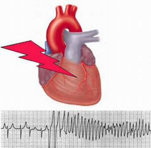 Rối loạn nhịp tim là biến chứng dễ gặp khi người cao tuổi bị sốt.