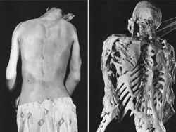 Người đàn ông 25 tuổi với căn bệnh loạn sản xơ xương hóa quá mức (FOP), và hình ảnh bộ xương của anh (trái).