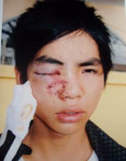 Cháu Hà Văn Lợi với vết thương trên mắt.