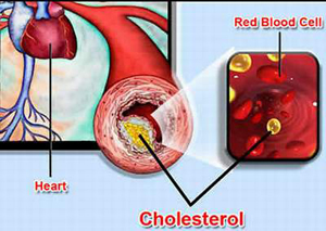 Mỡ máu có mối liên quan chặt chẽ với bệnh tim mạch. 

