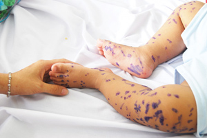 Bệnh nhi 1 tuổi mắc TCM nổi bóng nước đầy hai chân.