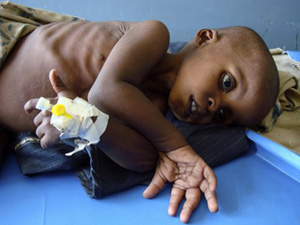 Một em nhỏ bị suy dinh dưỡng đang được điều trị tại bệnh viện ở Mogadishu, Somalia.
