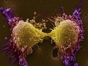 Tế bào ung thư tiền liệt tuyến. (Nguồn: lancastria.net)