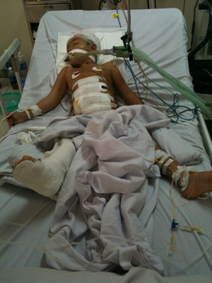 Bệnh nhân Lường Văn Quang sau khi phẫu thuật đa trấn thương tại BVĐK tỉnh
